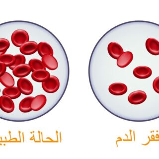 رسمة توضيحية لفقر الدم من خلال مجموعتين من كريات الدم الحمراء في الأولى يكون عدد الكريات الحمراء كثيراً وهي الحالة الطبيعية وفي الثانية يكون قليل وهي حالة فقر الدم