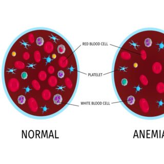 رسم توضيحي للفرق بين عينتين من الدم الأولى في الحالة الطبيعية والثانية عند الإصابة بفقر الدم الناتج عن نقص الحديد