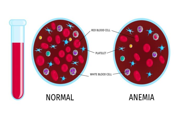 رسم توضيحي للفرق بين عينتين من الدم الأولى في الحالة الطبيعية والثانية عند الإصابة بفقر الدم الناتج عن نقص الحديد