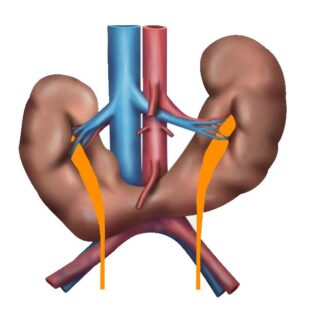 رسم توضيحي لكليتين ملتحمتين مع بعضهما البعض من الجهة السفلية