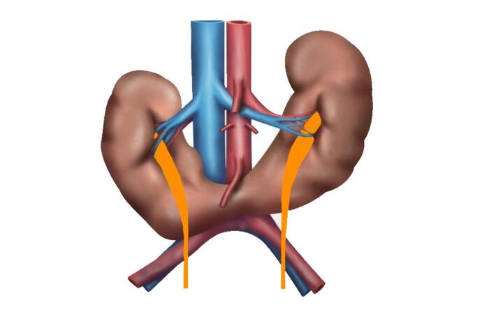 رسم توضيحي لكليتين ملتحمتين مع بعضهما البعض من الجهة السفلية