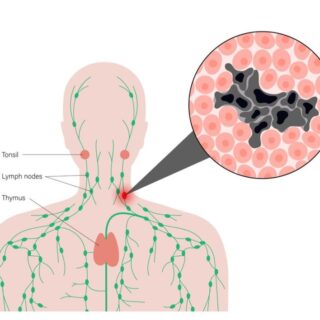 رسم توضيحي للمفوما هودجكن عند الأطفال