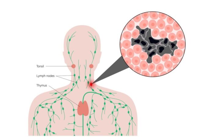 رسم توضيحي للمفوما هودجكن عند الأطفال