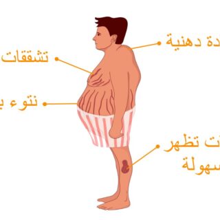 رسم توضيحي لشخص مصاب بمتلازمة كوشينغ وتظهر كتلة دهنية على رقبته من جهة الخلف بالإضافة الى بروز البطن للأمام وظهور تشققات جلدية ملونة