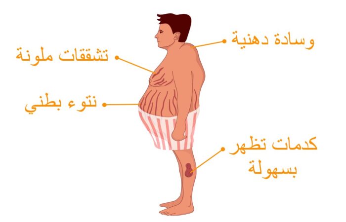 رسم توضيحي لشخص مصاب بمتلازمة كوشينغ وتظهر كتلة دهنية على رقبته من جهة الخلف بالإضافة الى بروز البطن للأمام وظهور تشققات جلدية ملونة