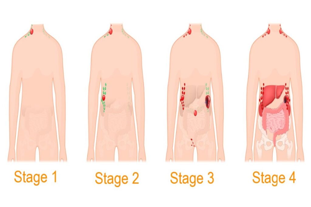 رسم توضيحي لمراحل الإصابة بلمفوما هودجكن عند الأطفال ونمو سرطان العقد اللمفاوية مع تقدم كل مرحلة