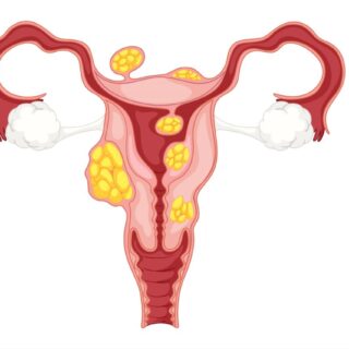 رسم توضيحي لتوزع كتل غريبة الشكل على الجهاز التناسلي للمرأة
