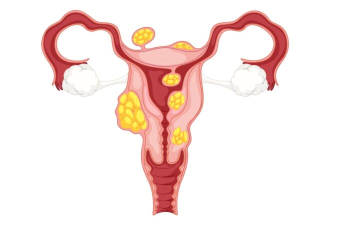 رسم توضيحي لتوزع كتل غريبة الشكل على الجهاز التناسلي للمرأة