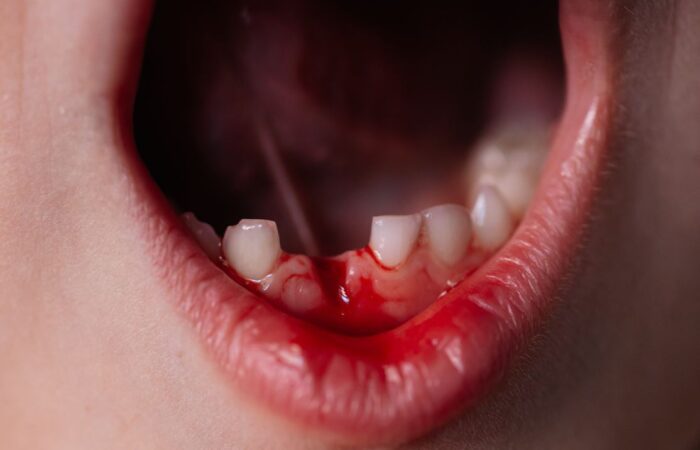 دم يسيل من فم صبي بعد قلع سنه