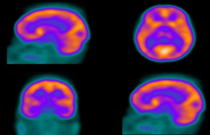 صورة للدماغ ملتقطة بالتصوير الومضاني