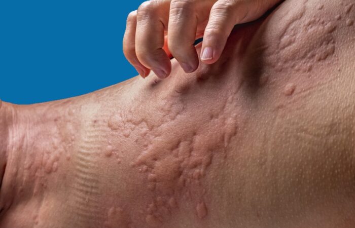 القسم الخلفي من جسد شخص بالغ وتظهر انتفاخات جلدية حمراء بسب الإصابة بصدمة تحسسية