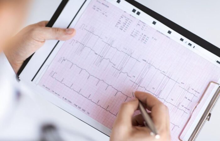 طبيب يحمل ورقة تخطيط بياني للقلب