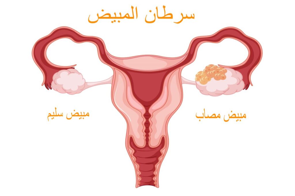 رسم تشريحي للجهاز التناسلي عند المرأة مع وجود العديد من الكريات الصغيرة على الجهة اليمنى من الجهاز التناسلي
