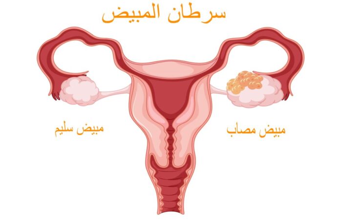 رسم تشريحي للجهاز التناسلي عند المرأة مع وجود العديد من الكريات الصغيرة على الجهة اليمنى من الجهاز التناسلي
