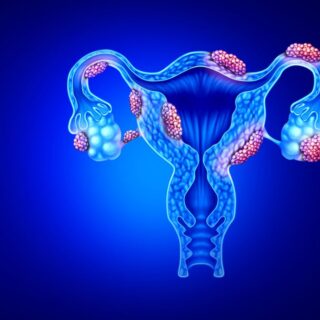 رسمة توضيحية للانتباذ البطاني الرحمي الذي يصيب الجهاز التناسلي الأنثوي