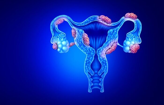 رسمة توضيحية للانتباذ البطاني الرحمي الذي يصيب الجهاز التناسلي الأنثوي