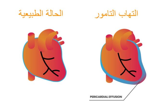 رسم توضيحي للقلب عند تعرضه لالتهاب التامور