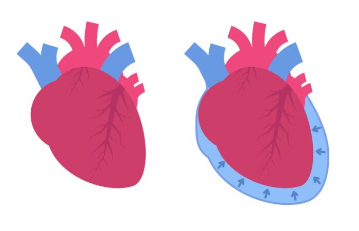 رسم توضيحي للقلب عند الإصابة بالسطام التاموري