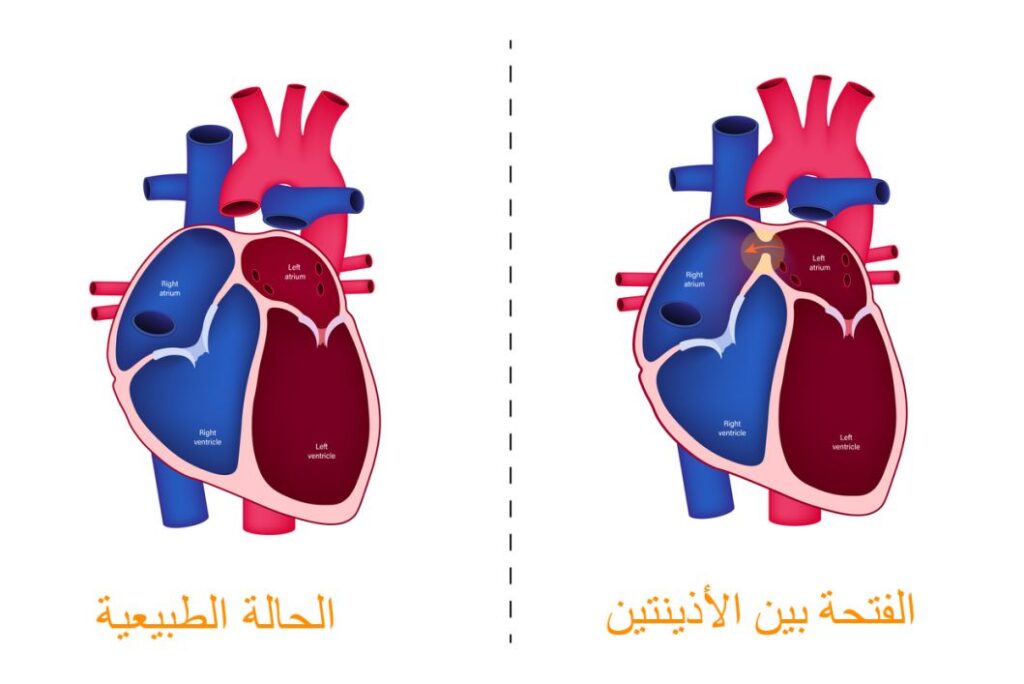 رسم توضيحي للفتحة بين الأذينتين لدى قلب الإنسان