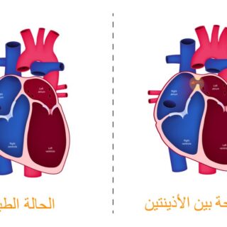 رسم توضيحي للفتحة بين الأذينتين لدى قلب الإنسان