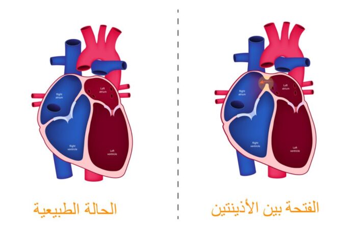 رسم توضيحي للفتحة بين الأذينتين لدى قلب الإنسان