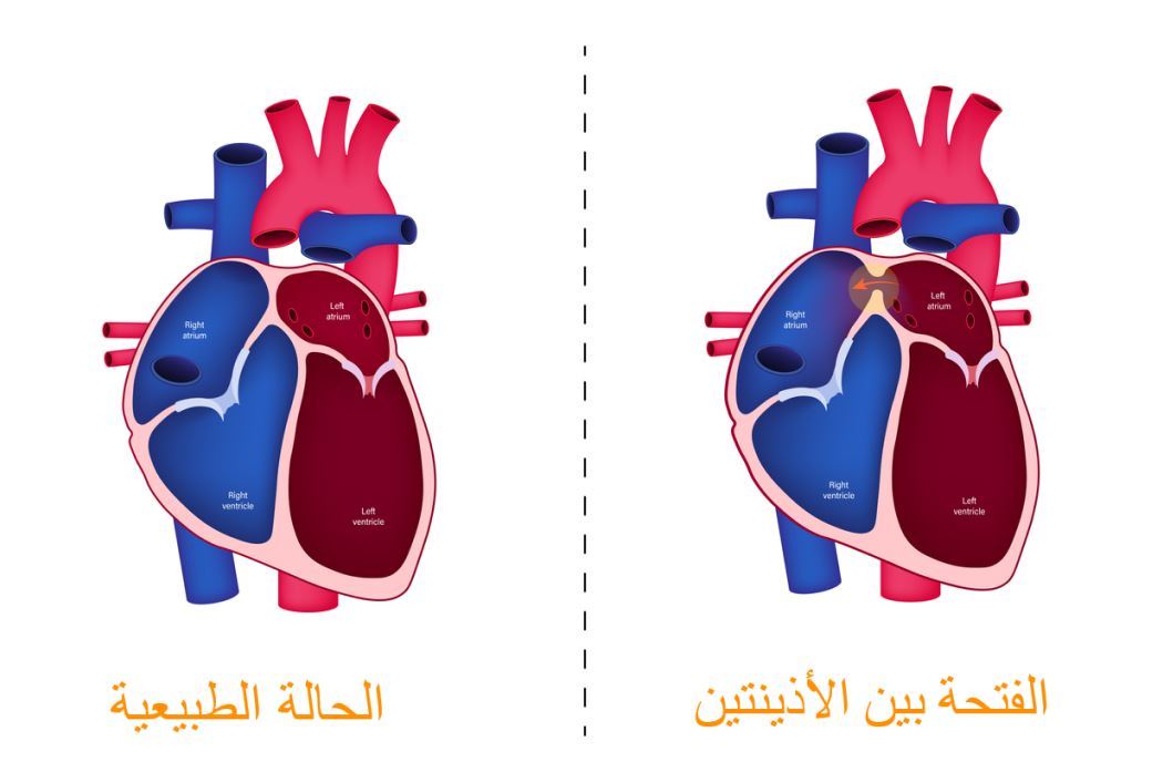 الفتحة بين الأذينتين لدى قلب الإنسان