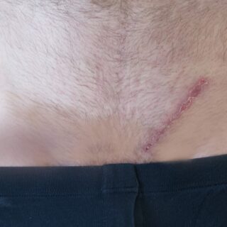 ندبة جراحية كبيرة أسفل بطن رجل بالغ فوق الخصية الشمالية