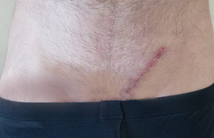 ندبة جراحية كبيرة أسفل بطن رجل بالغ فوق الخصية الشمالية