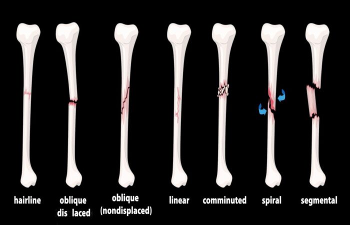 رسم توضيحي لأشكال الكسور المختلفة في عظمة طويلة