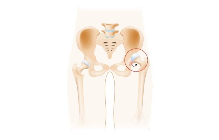 رسم توضيحي لرأس عظم الفخذ وهو خارج التجويف الحقي للورك