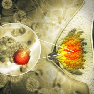 رسم تشريحي لثدي المرأة وظهور لسرطان الثدي على شكل كتل حمراء اللون داخل خلايا الثدي