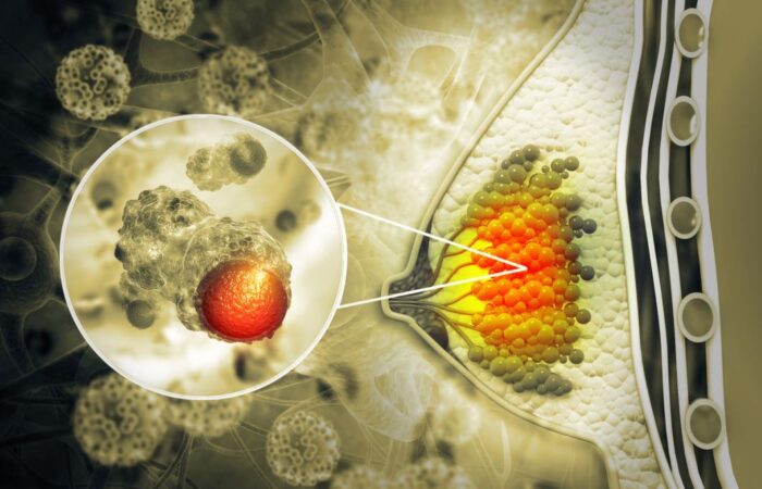 رسم تشريحي لثدي المرأة وظهور لسرطان الثدي على شكل كتل حمراء اللون داخل خلايا الثدي