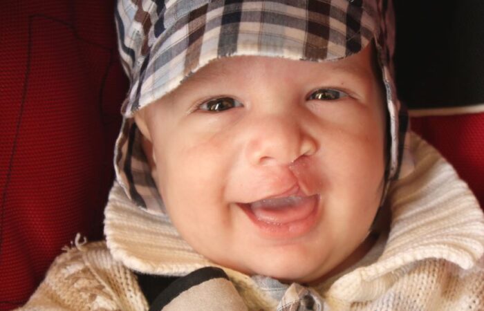 طفل صغير يرتدي قبعة مخططة باللون البني والأبيض ويوجد شق ملتحم في شفته العلوية