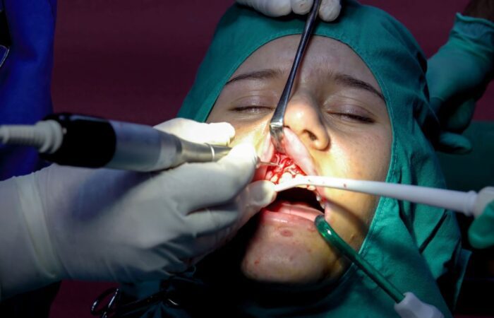 طبيب يقوم بعملية جراحية في اللثة العلوية داخل فم مريض
