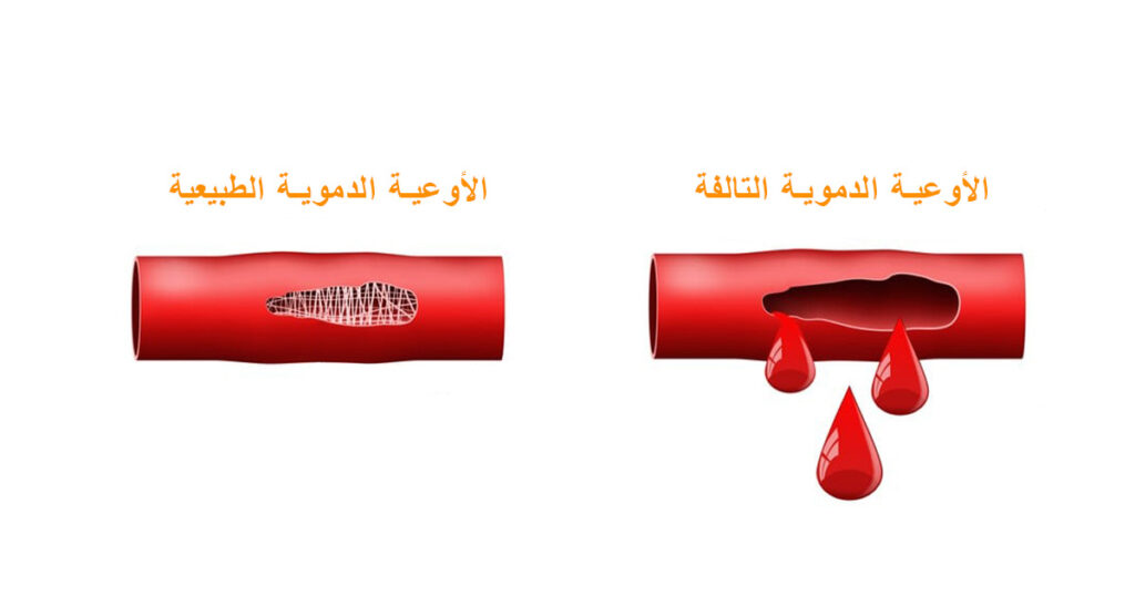 رسم توضيحي لوعاء دموي سليم ووعاء دموي تالف يقطر سائلاً أحمر