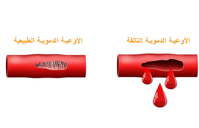 رسم توضيحي لوعاء دموي سليم ووعاء دموي تالف يقطر سائلاً أحمر