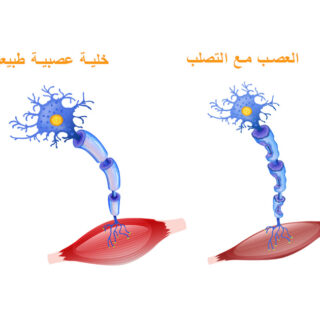رسم توضيحي لعصبون سليم وعصبون مصاب