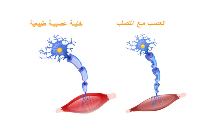 رسم توضيحي لعصبون سليم وعصبون مصاب