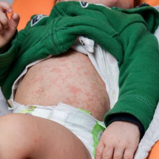 طفل رضيع يرتدي كنزة خضراء ويظهر على بطنه بقع حمراء كثيفة