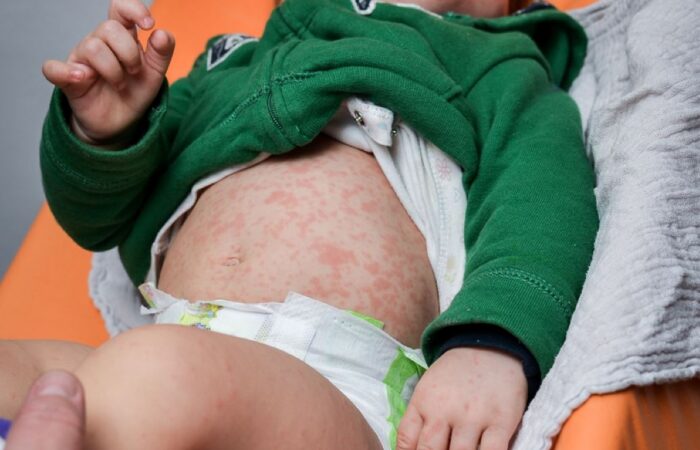 طفل رضيع يرتدي كنزة خضراء ويظهر على بطنه بقع حمراء كثيفة