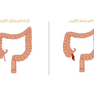 رسم توضيحي للأمعاء الغليظة عند الإنسان قبل وبعد الزائدة الدودية