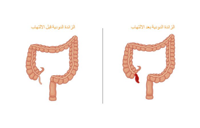 رسم توضيحي للأمعاء الغليظة عند الإنسان قبل وبعد الزائدة الدودية