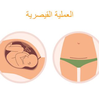رسم توضيحي لشق جراحي ببطن المرأة نتيجة ولادة الطفل