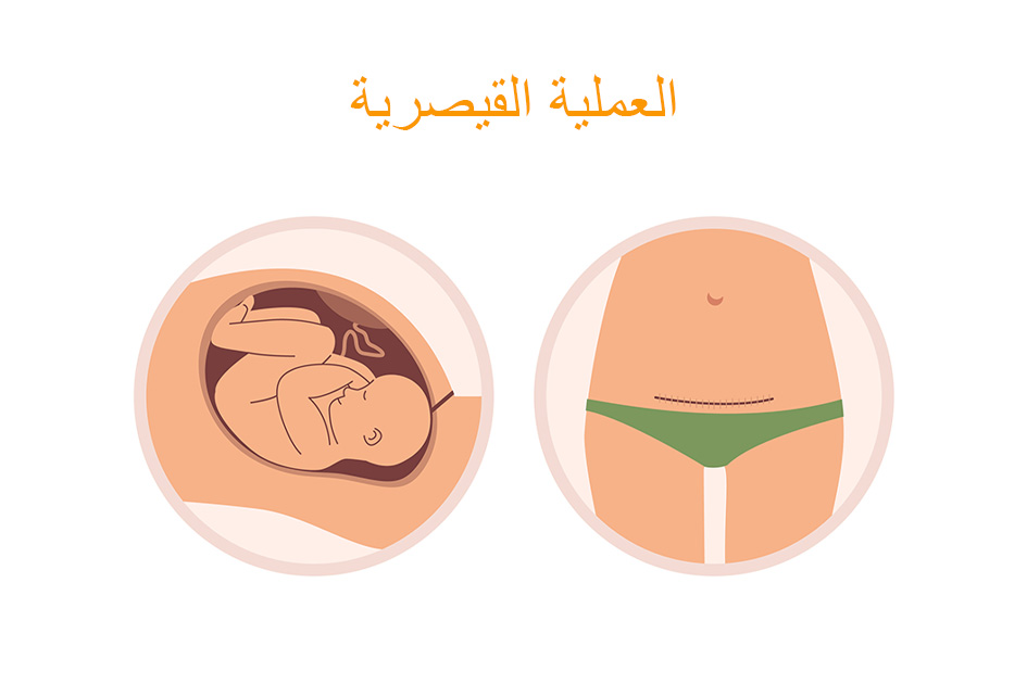 رسم توضيحي لشق جراحي ببطن المرأة نتيجة ولادة الطفل