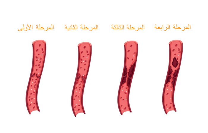 المراحل الأربعة لآلية التخثر الطبيعية