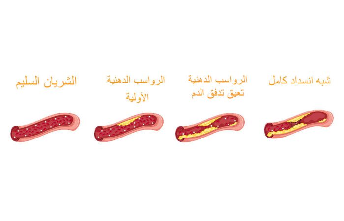 رسم توضيحي يبيّن مراحل تشكل الترسبات داخل الشريان