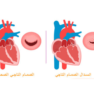 رسم توضيحي لانسدال الصمام التاجي داخل القلب