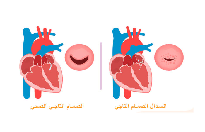 رسم توضيحي لانسدال الصمام التاجي داخل القلب