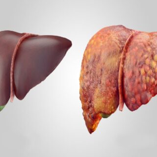 شكل الكبد التالف بعد إصابته بالتشمع ويكون على شكل كتلة مليئة بالانتفاخات والجروح