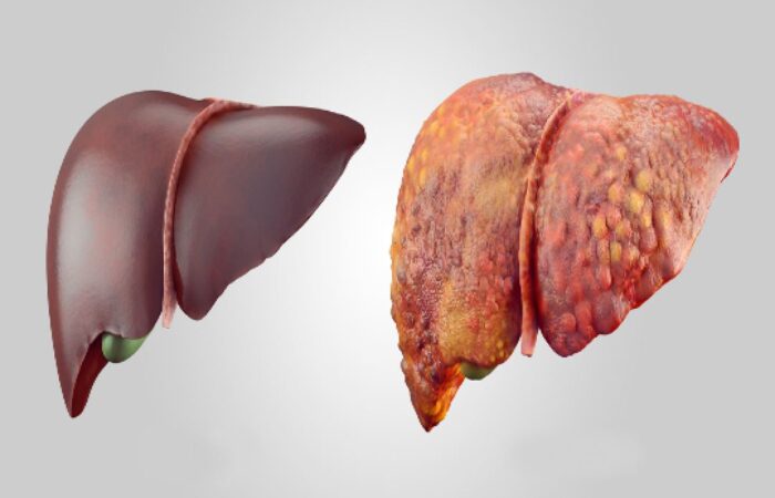 شكل الكبد التالف بعد إصابته بالتشمع ويكون على شكل كتلة مليئة بالانتفاخات والجروح